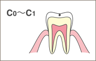 虫歯1