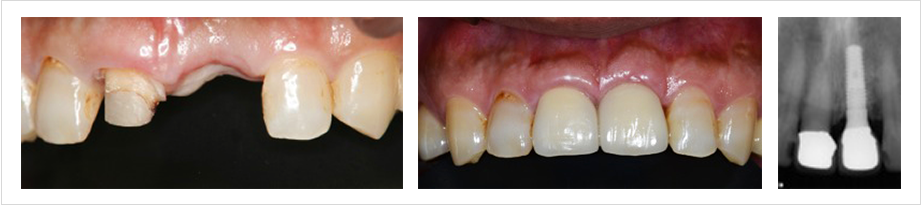 ●2回法による前歯部のインプラント症例の写真