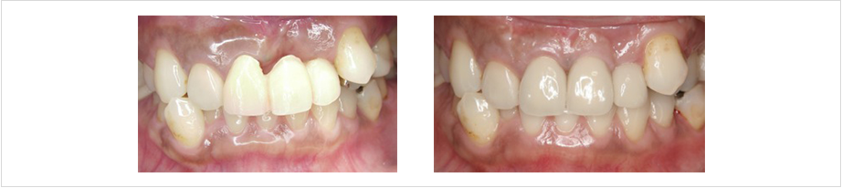 ●GBR(骨造成法)による前歯部インプラント２回法の写真