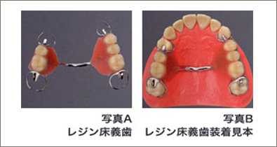 入れ歯の種類1