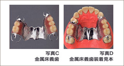 入れ歯の種類2