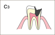虫歯3