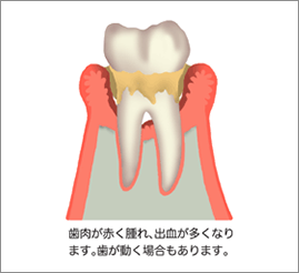 中期の歯周病2