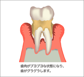 後期の歯周病