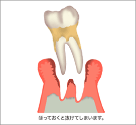 後期の歯周病2